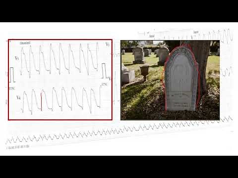 ECG I MYOCARDIAL INFARCTION I TOMBSTONE PATTERN I CARDIAC EMERGENCY I ST ELEVATION