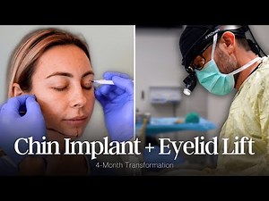 Blepharoplasty and Chin Implant Journey | 4-Month Reveal