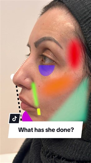 One session. A completely redefined face. The art of balance and beauty. Full-face harmonisation using premium hyaluronic acid filler — every contour enhanced, every angle refined. This treatment restores proportion, definition and youthfulness while keeping the results beautifully natural. At Aesthetics by K.K., we tailor each session to your unique facial structure — because true harmony is never “one-size-fits-all.” 📞 Ready to start your transformation? 💌 DM us directly or call/WhatsApp  44