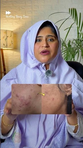 Severe Acne Cleared in 15 Days ✨ Real Healing Story | Dr. Arwa Bohra