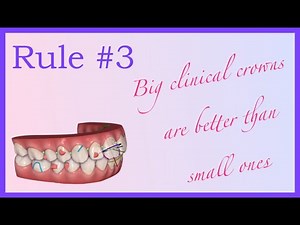 Big teeth, no problems! - Invisalign Mini Course 4 of 8