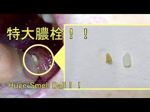 【膿栓】指で臭い玉を取る⛏✨_Removing huge Smell ball by finger