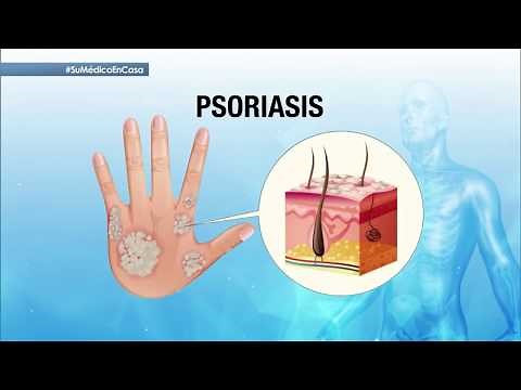 Psoriasis en la piel: síntomas y tratamiento | Su Médico en Casa