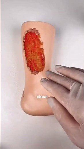 Curativo na úlcera venosa com hiperqueratose do jeito certo #feridas #curativos #shorts
