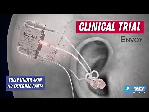 Fully Implanted Cochlear Implant Clinical Trial to Take Place at Mayo Clinic