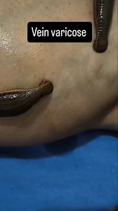 Vein varicose cure by leech therapy #breakfastoptions #balance #viralvideos #power #beauty #shorts #humanity #saturdaymorning #YogiAdityanath #deit #shortsviral | Vaidya Pawan Kaushik
