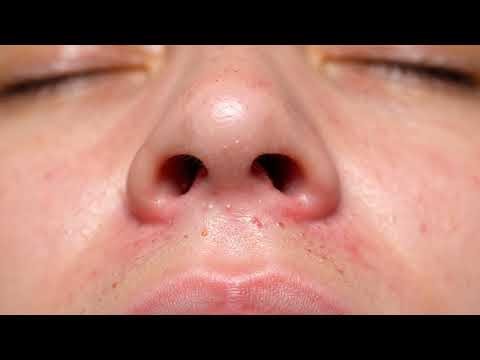 ULTIMATE Blackhead Removal Compilation: Deep & Satisfying Extractions ✨🤯