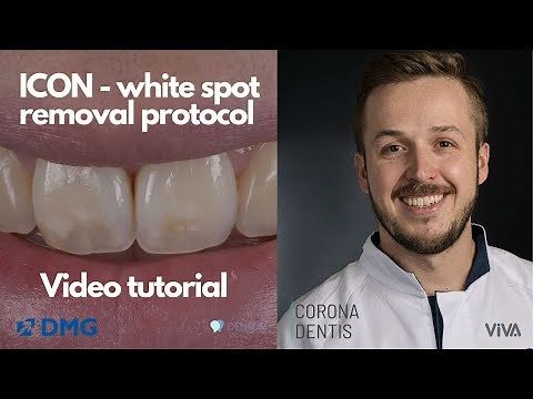 ICON procedure - step by step (explained)