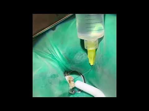 Root canal therapy of tooth 31 from start to finish!