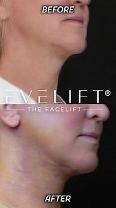 Before And After: Facial Rejuvenation