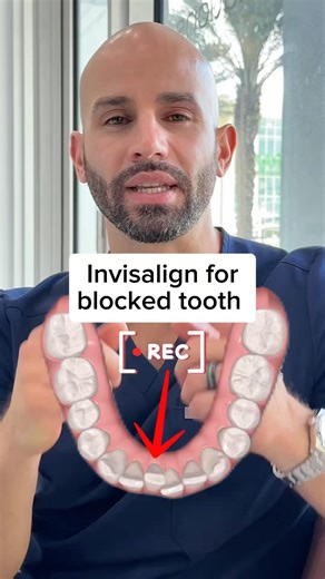 How does Invisalign make space for a blocked lower tooth? ￼