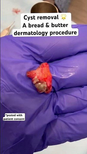 How a cyst is removed on the back by a dermatologist