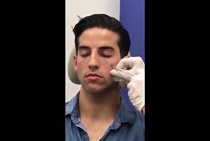 Pec Enhancements, Jawline, and Liposculpting in NYC