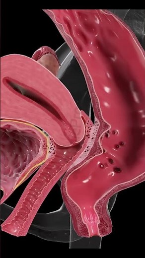 Endometriosis Beyond the Uterus #anatomy #3danimation #scienceshorts