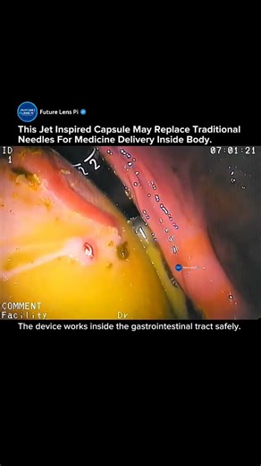 Cephalopod Inspired Microjet Capsule Could Replace Needles Forever #medical #treatment #tech #shorts