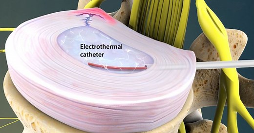 Intradiscal Electrothermal Therapy (IDET): Overview, Procedure