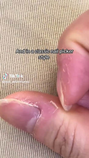 nail adventures (@nail_adventures) - Removing Stubborn Skin Piece on Nail | Day in the Life of a Nail Picker