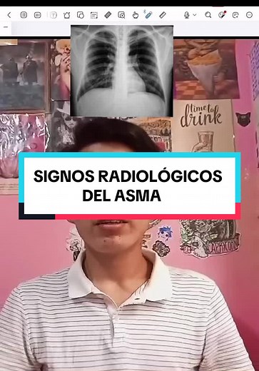 Signos Radiológicos del Asma en Radiografías de Tórax