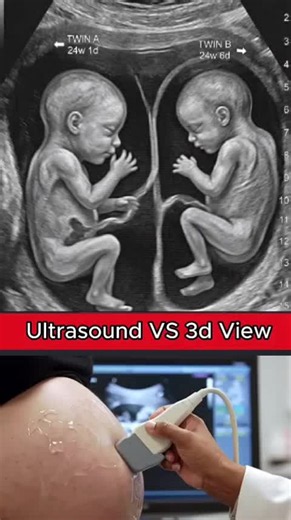 Twins Ultrasound Scane #pregnancyjourney #ultrasoundscane #twinsultrasound #babymovement