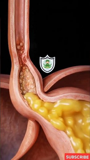 Acid Reflux, GERD and Heartburn