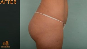 The Doctor Explains Butt Augmentation Options