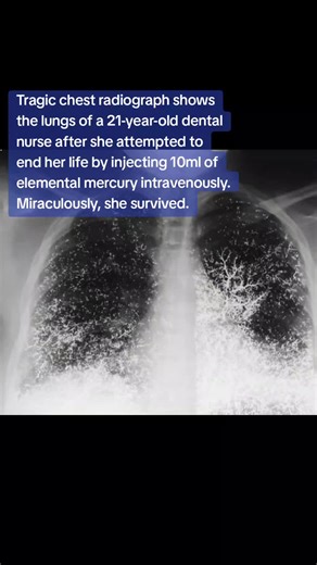 Tragic chest radiograph shows the lungs of a 21-year-old dental nurse after she attempted to end her life by injecting 10ml of elemental mercury intravenously. Miraculously, she survived.