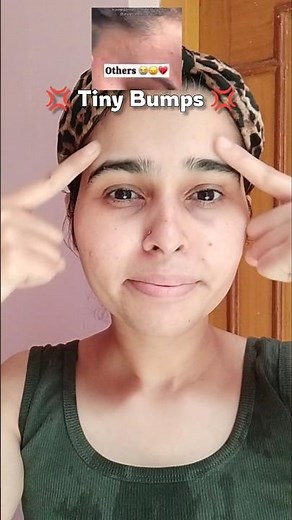 3steps tiny bumps Routine ✨💢 #skincareroutine #shorts #viral #tinybumps #homeremedy #remove #diy