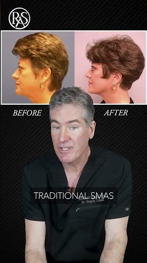 Beautiful Facelift & Necklift Results - Dr. Gregory Lynam - RSA