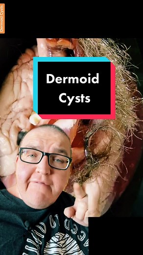 Dermoid Cysts Explained: What You Need to Know
