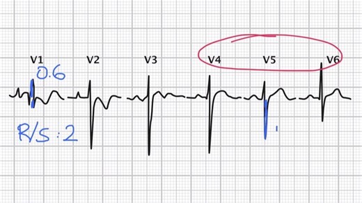 02.04 Ventricular hypertrophy quiz