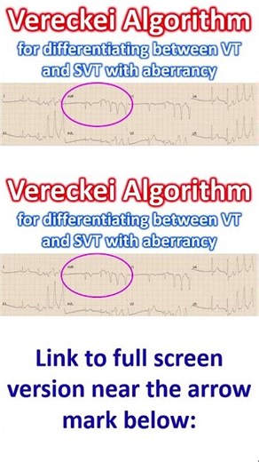 Vereckei Algorithm for differentiating between VT and SVT with aberrancy