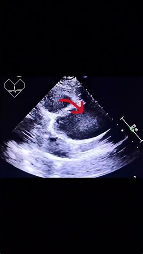 Aortic Dissection can be subtle on TTE