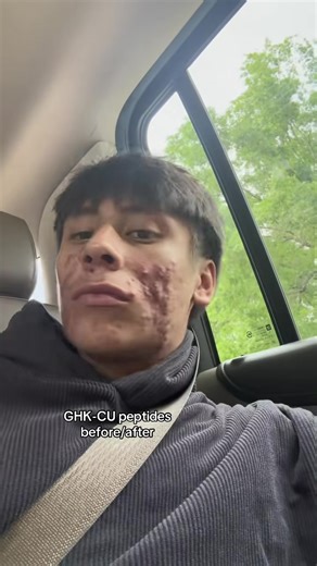 Restore Facial Contours with Copper Peptides