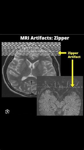 Shubham Deoli on Instagram: "An MRI artifact is a feature appearing in a magnetic resonance image that is not present in the original object. These artifacts can be caused by various factors including hardware issues, software problems, physiological phenomena, or physical limitations of the MRI device. While some artifacts may be easily dismissed, others can be confused with pathology, potentially leading to misdiagnosis Susceptibility Artifacts: These are often seen around metallic implants, s