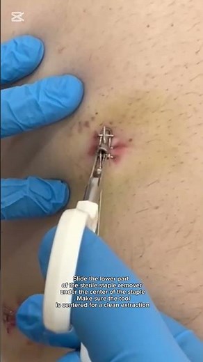 ​Surgical Staple Removal Step-by-Step 🏥 #Shorts#تمريض #nursing