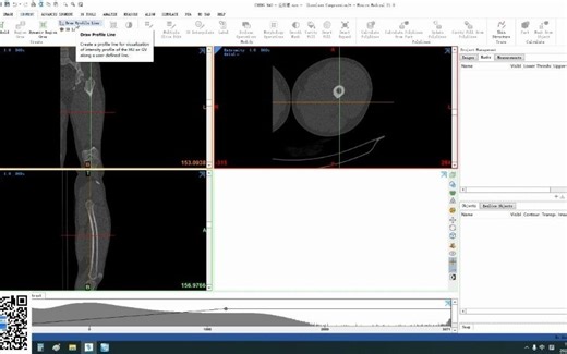 股骨有限元分析（生物力学 A）-在mimics和geomagic里完成三维模型重建及平滑处理