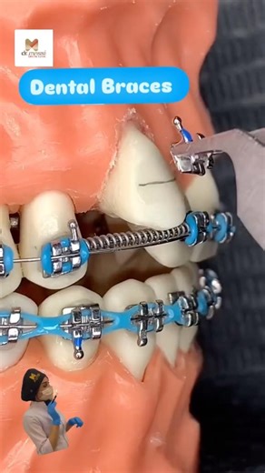 Best Braces Color? Light Blue