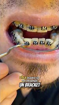 Bracket came loose 😮‍💨 #dentist #bracket