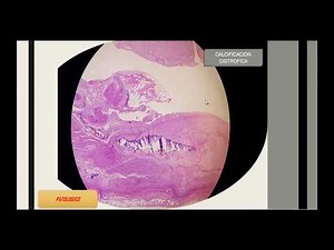 CALCIFICACION DISTROFICA - ARTERIA - LAMINAS DE PATOLOGIA