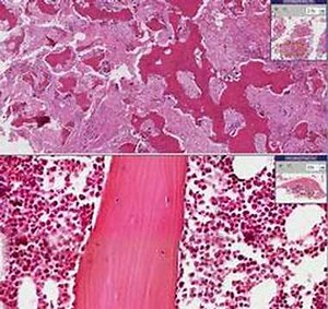 Histopathology Bone--Paget disease