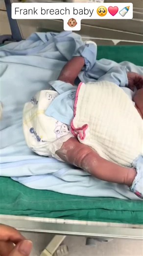 Girl Post naija💖 on Instagram: "frank breech baby is when the baby come out with her buttocks instead of the head during delivery,the buttocks are down and the legs are folded straight up by the head. After birth, the baby’s legs may stay up for some days or even weeks before they go down on their own. In most hospitals they don’t allow you to deliver breech babies using the vjay they’ll recommend a C-section for safety. . So whether by CS or vaginal delivery,the baby’s legs may still stay in t