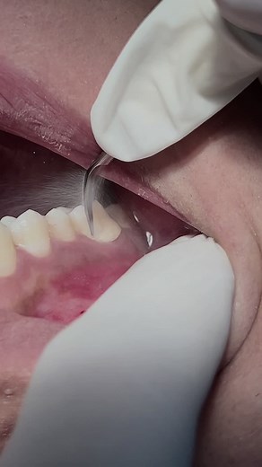 Removing Tartar and Calculus from Teeth: Dentist's Guide