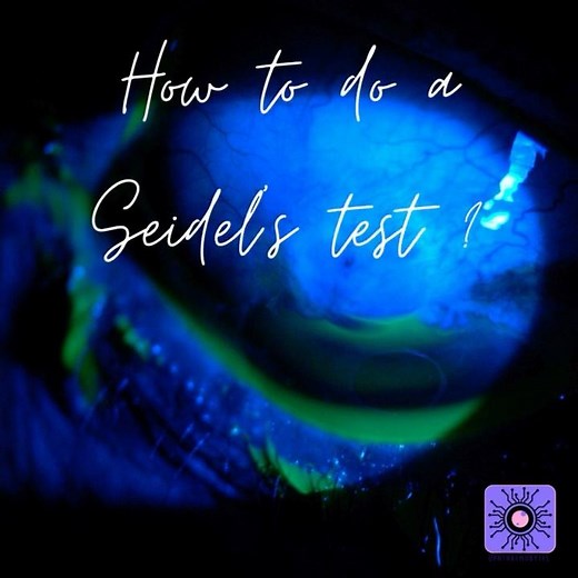 Ophthalmology in Motion: Seidel's Test