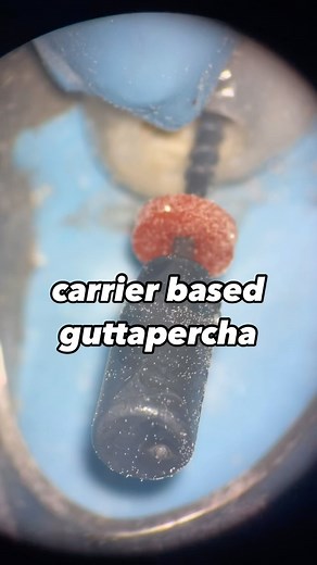 6.4K views · 36 reactions | Carrier based gutta-percha | Abdelrahman Ahmed Tawfik | Facebook