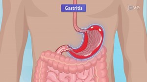 Video: Gastritis-I: Introduction and Types