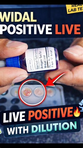 Well Being Diagnostic | Health Tests on Instagram: "Widal Test Positive or Negative? | Live Agglutination Explained Widal Test ek common serological test hai jo Typhoid (Salmonella Typhi) detect karne ke liye use hota hai. Is video me hum LIVE Widal Test dikha rahe hain aur clearly explain kar rahe hain: 🔬 Widal Test Positive kaise dikhta hai 🔬 Negative reaction kaise pehchane 🔬 Agglutination ka real meaning 🔬 Dilution ka role result interpretation me ⚠️ Ye video educational purpose ke liye 