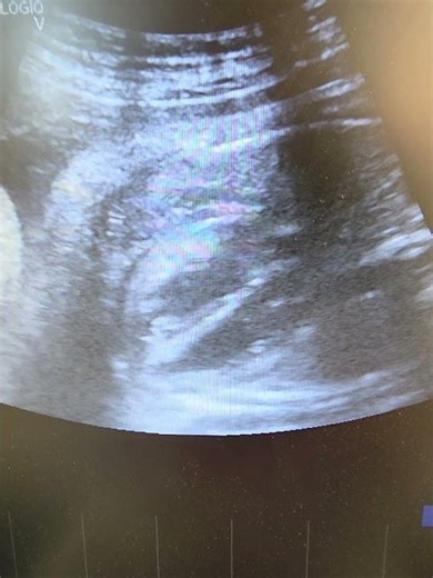 #طب_التوليد #جنين #تخطيط_الصدى #Obstetrics #FetalEcho #Ultrasound #MedicalEducation