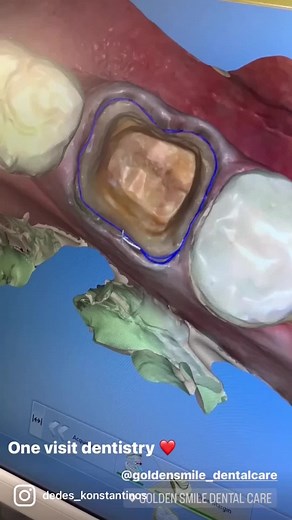 Creating and Fitting Dental Prosthesis in One Visit