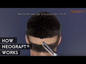 Animation on How NeoGraft® Works