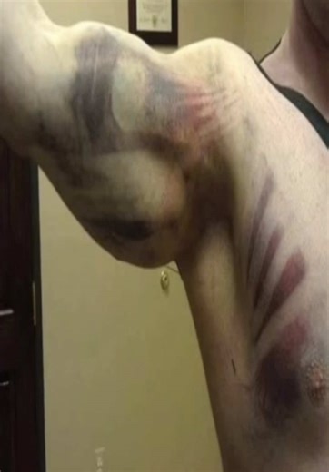 Understanding Bruises: The Colorful Healing Process